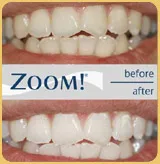 Whitening Before & After